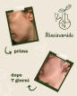 Foto prima e dopo utilizzo del siero Niacinamide e Zinco - trattamento 7 giorni