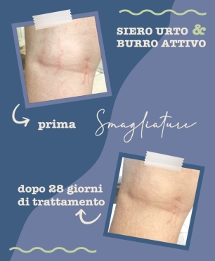 Foto Prima e Dopo l'utilizzo del siero smagliature dopo 28 giorni