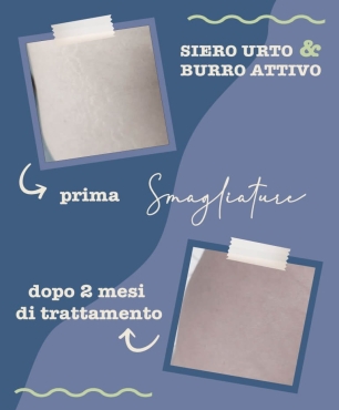 Foto Prima e Dopo trattamento antismagliature dopo 2 mesi